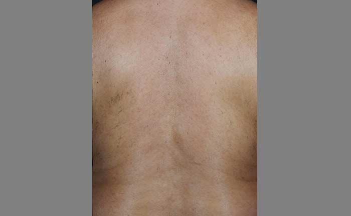 The image shows a close-up view of a person s back with visible skin imperfections, possibly acne or blemishes.