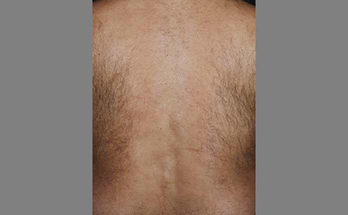 The image shows a close-up view of a person s back with visible hair growth, likely for a medical or cosmetic context.