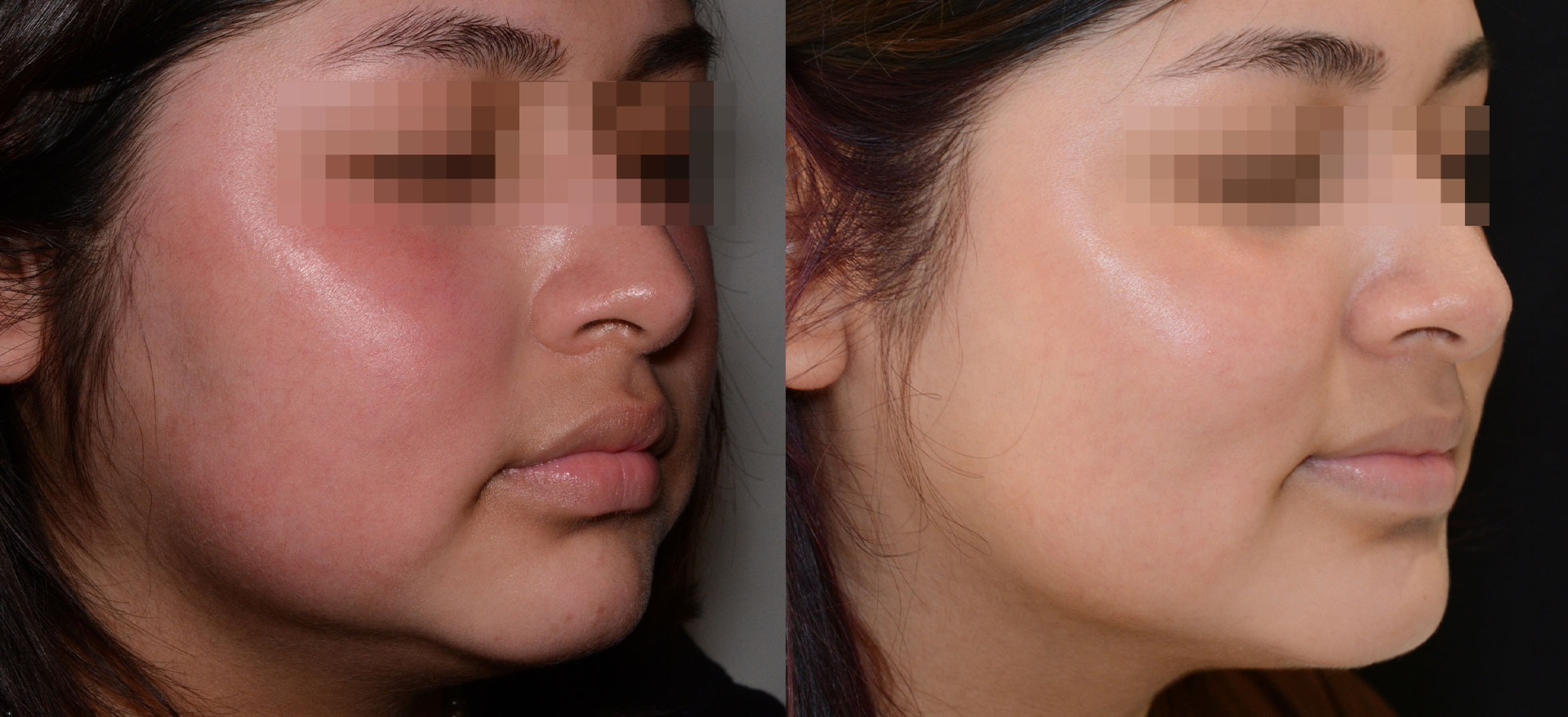 The alt text should be descriptive but neutral, focusing on the content of the image without making assumptions about its purpose or context. Here s an example A split-screen comparison showing a person with skin issues before and after treatment.