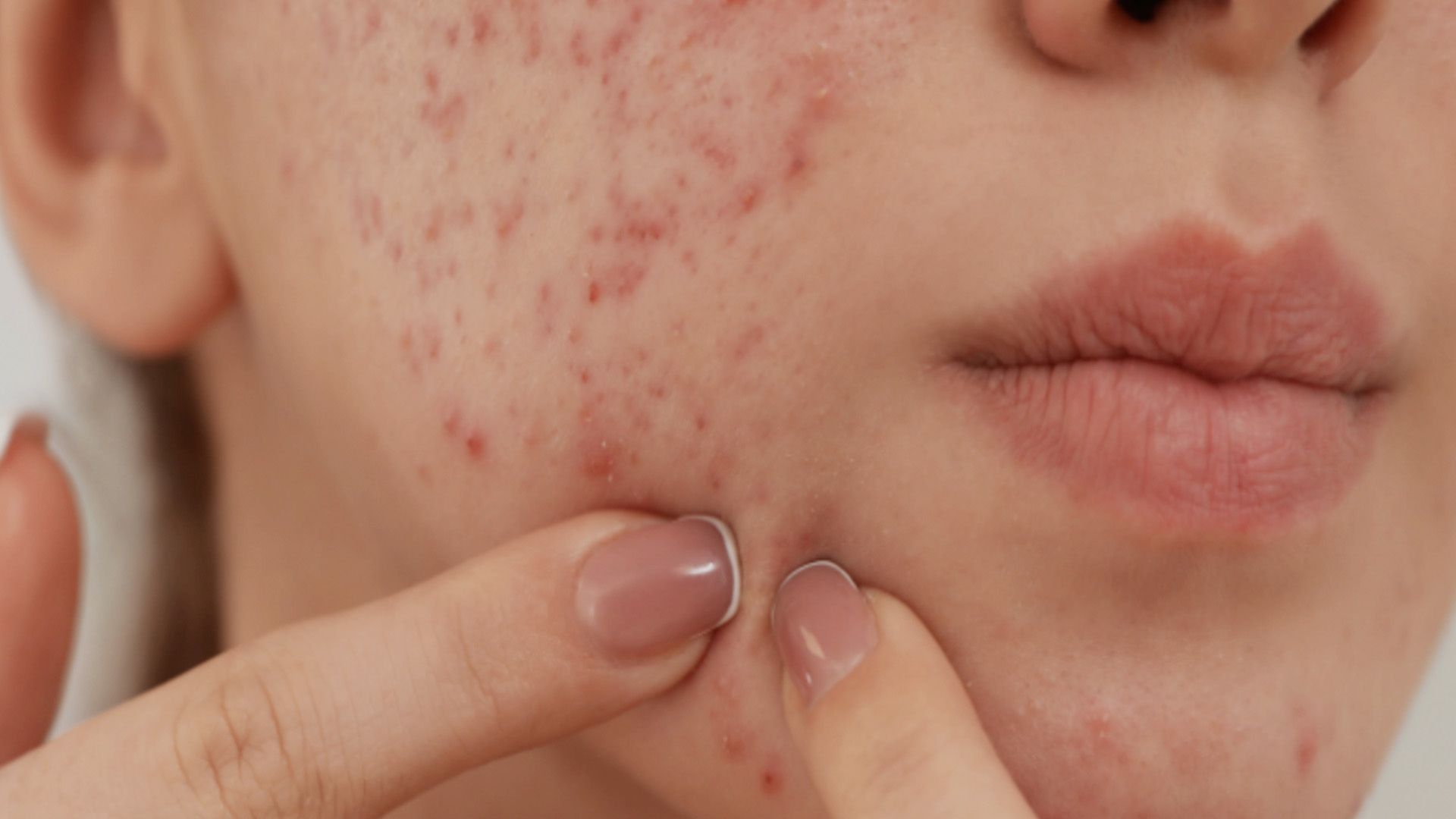 The image shows a close-up view of a person s face with visible acne, highlighting skincare concerns.