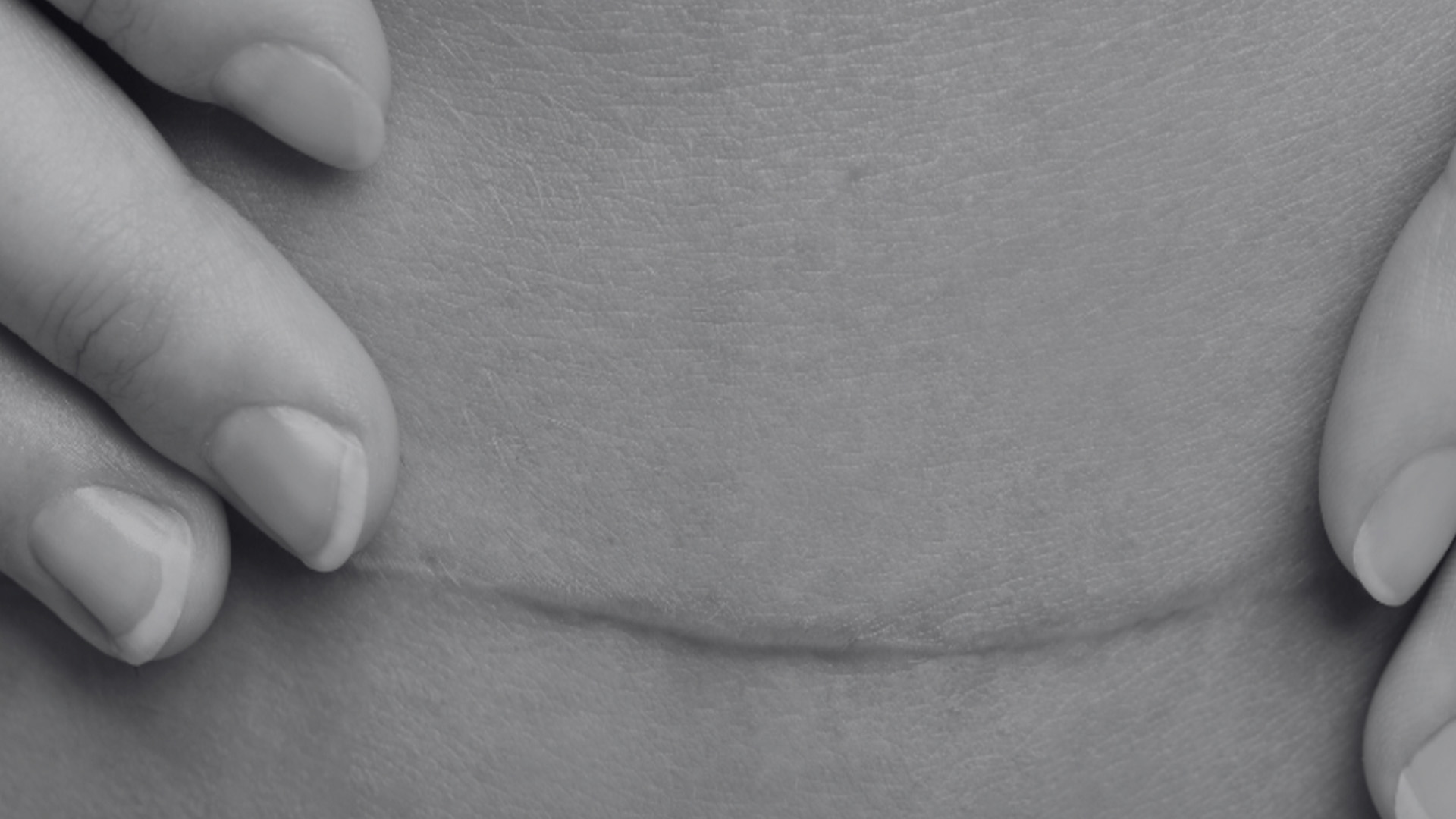 The image shows a close-up view of a person s stomach with a visible scar, possibly from surgery, with a hand gently resting on the area.