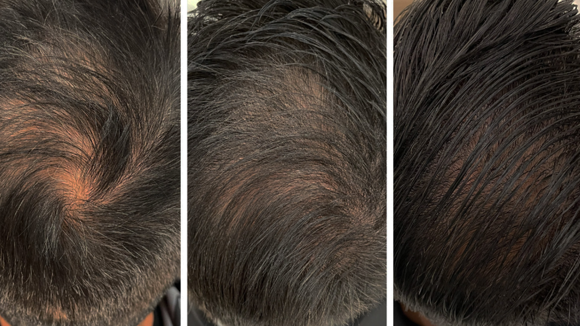 The image shows a collage of three photos featuring the back of a person s head with visible hair loss, highlighting different stages of hair thinning.