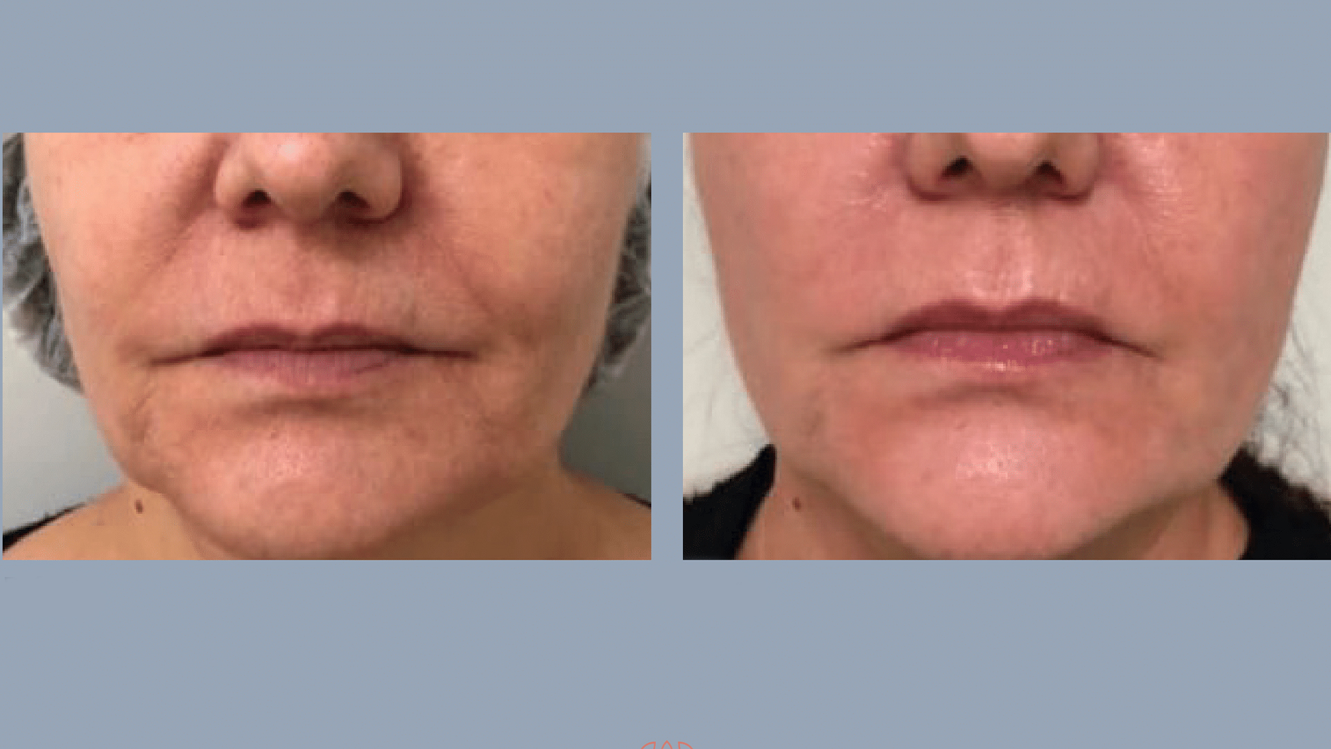 Central Park Laser Aesthetics | Hyperpigmentation Treatment, Stretch Mark Treatment and Injectables