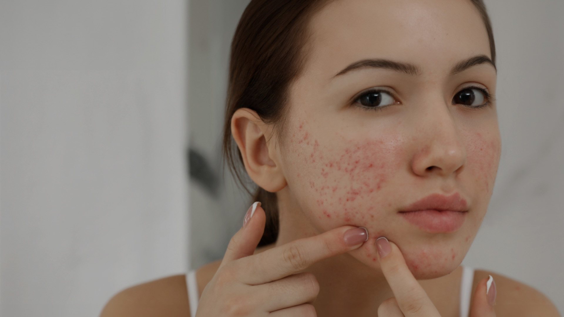 A woman with acne applying skincare products to her face.