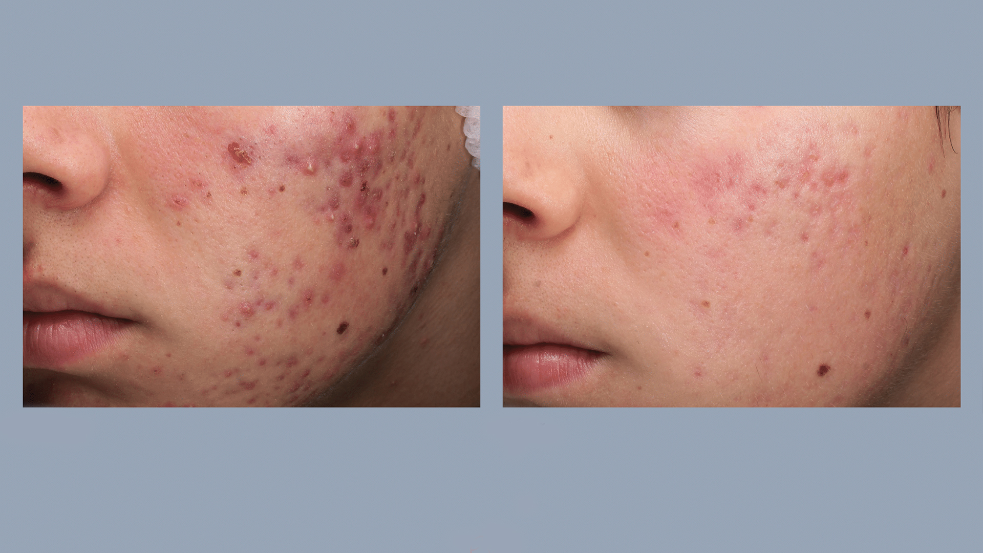 Central Park Laser Aesthetics | KeraHair Regrowth, Acne Treatment and Co2 Laser Resurfacing