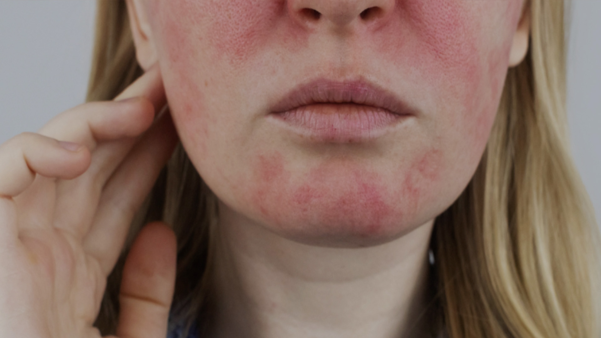The image shows a person with a noticeable red rash on their face, likely due to acne or skin irritation.