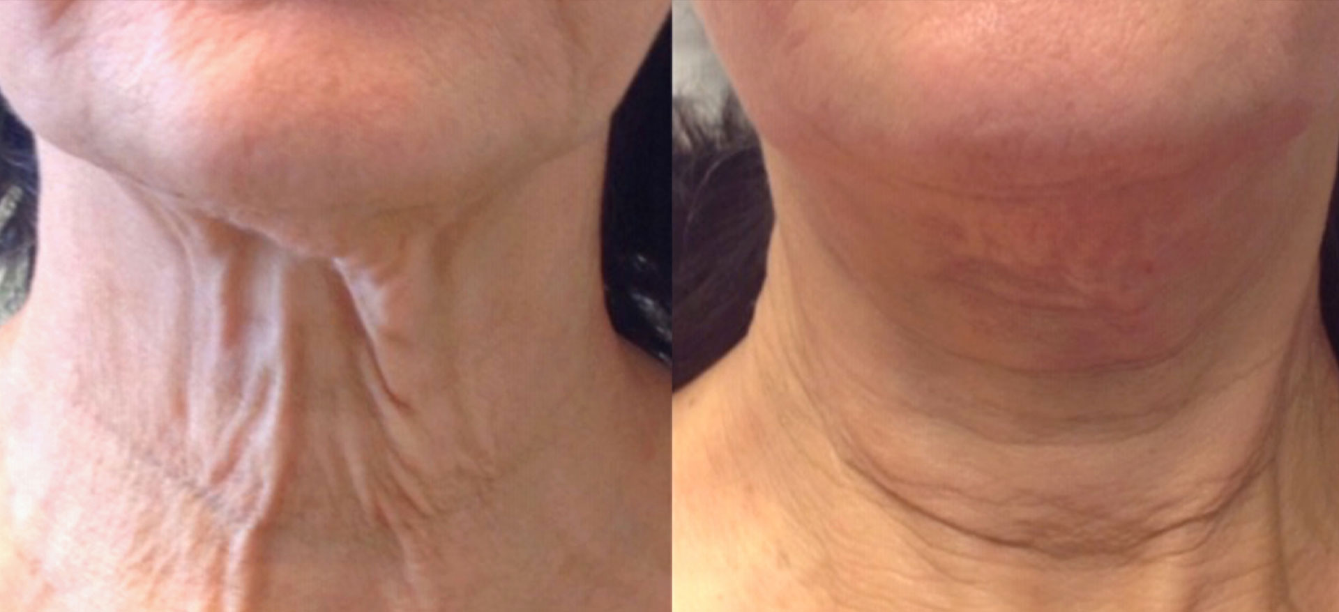 The image shows a split-screen comparison of a person s skin before and after treatment, highlighting the effectiveness of skincare products.