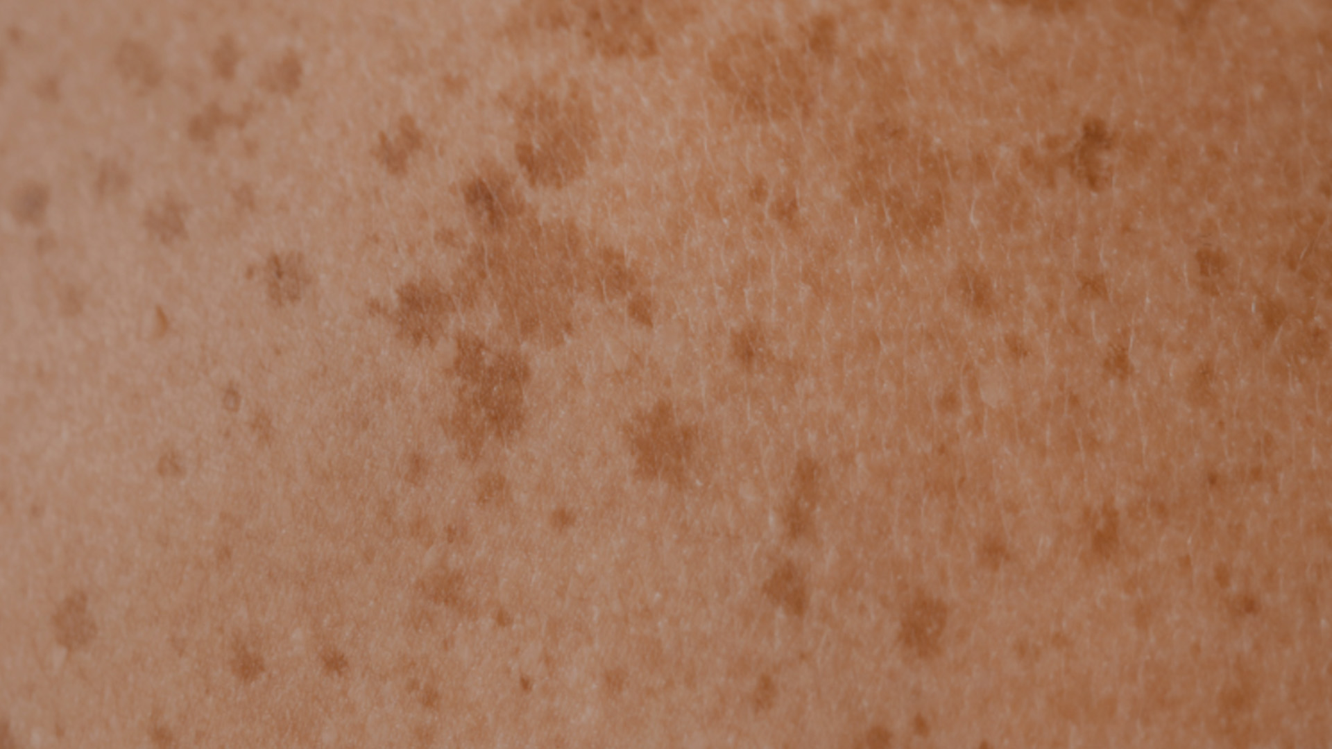 The image shows a close-up view of a person s skin with visible freckles, set against a blurred background that appears to be a different texture, possibly another skin area or a fabric with a pattern.