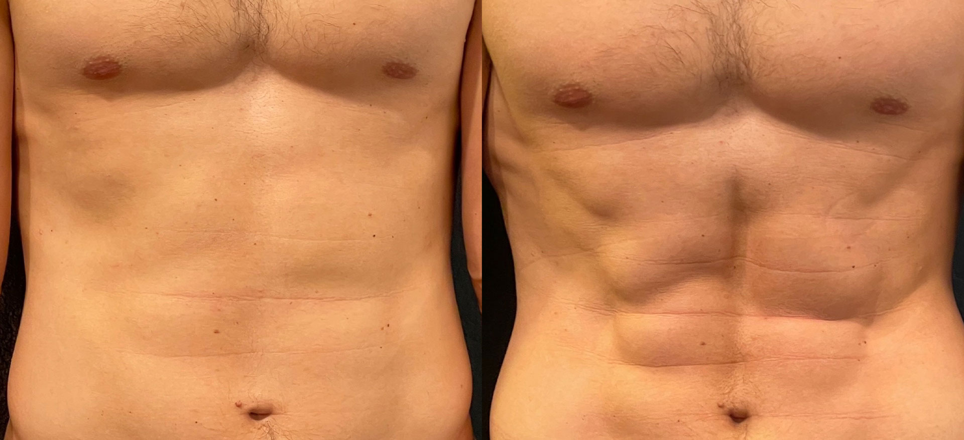 The image displays two side-by-side photographs of a person s torso, showcasing before and after body contouring results with visible muscle definition on the right side.