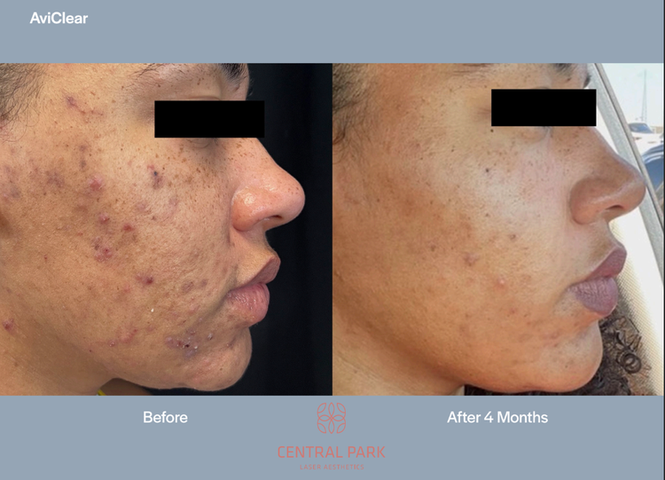 The image shows two side-by-side photos of a person s face with visible acne before and after treatment, highlighting the results of an acne treatment.