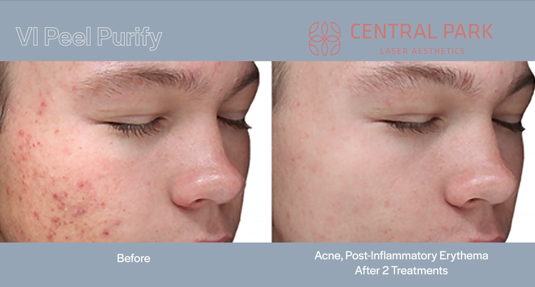 The image displays a before-and-after comparison of skin treatments using acne treatments and post-inflammatory erythema after treatments, showcasing the results of a skincare product or service.