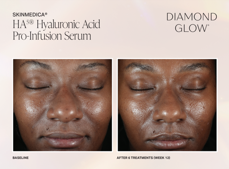 The image shows a split-screen comparison of a person s skin before and after treatment with HydroGlow Hyaluronic Acid Pro-Infusion Serum, highlighting the product s effects on skin texture and appearance.