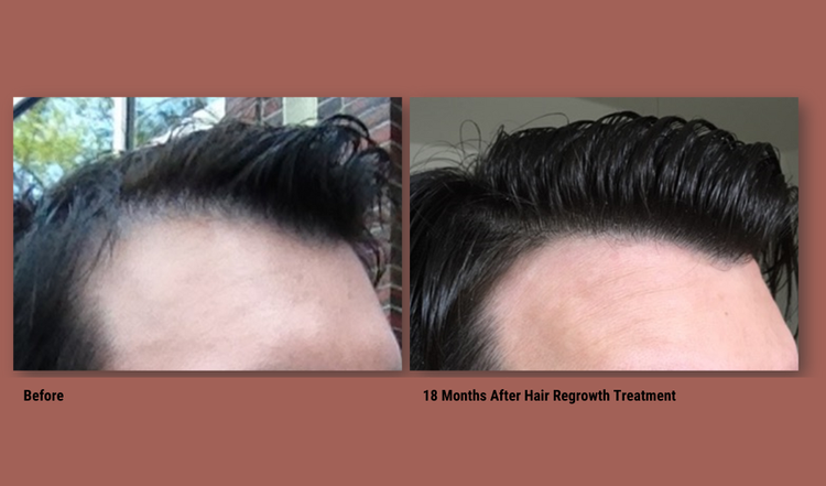 The image shows a man s hair transformation with a before-and-after comparison, highlighting the result of a 12-month hair treatment.