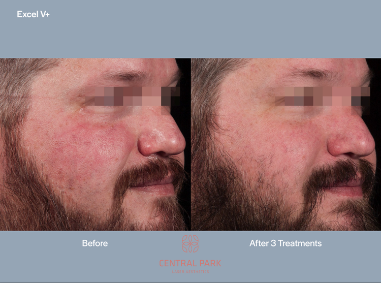 The image displays a before-and-after comparison of a man s skin after undergoing three treatments at Central Park Skin Clinic, with visible improvement in the post-treatment photo.