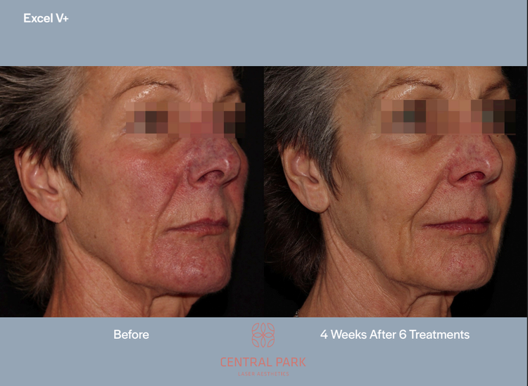 The image shows a before-and-after comparison of a woman s skin after six weeks of treatments at Central Park, with text indicating  EXCEL V  and an arrow pointing from the left to the right side of the image.