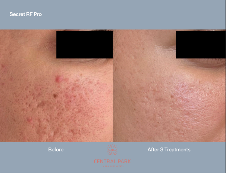 The image shows a before-and-after comparison of skin treatments, with the left side showing a person s face with visible acne and the right side showing the same area after treatment, appearing clearer.