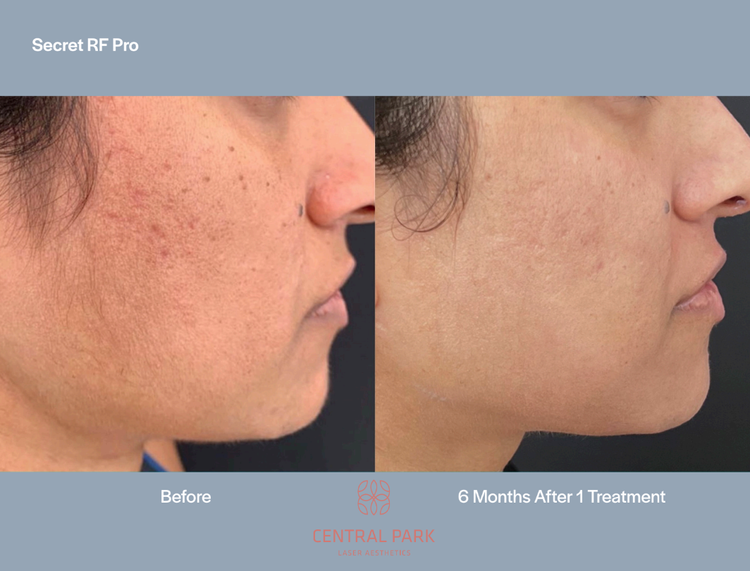 The image displays a split-screen comparison of a person s skin before and after treatment, highlighting the results of a cosmetic procedure.