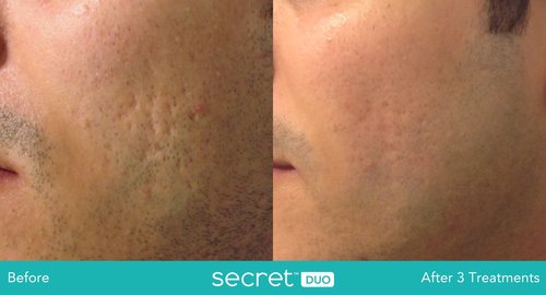 The image shows a split-screen comparison of a person s skin before and after a skincare treatment, highlighting the results achieved by the product.