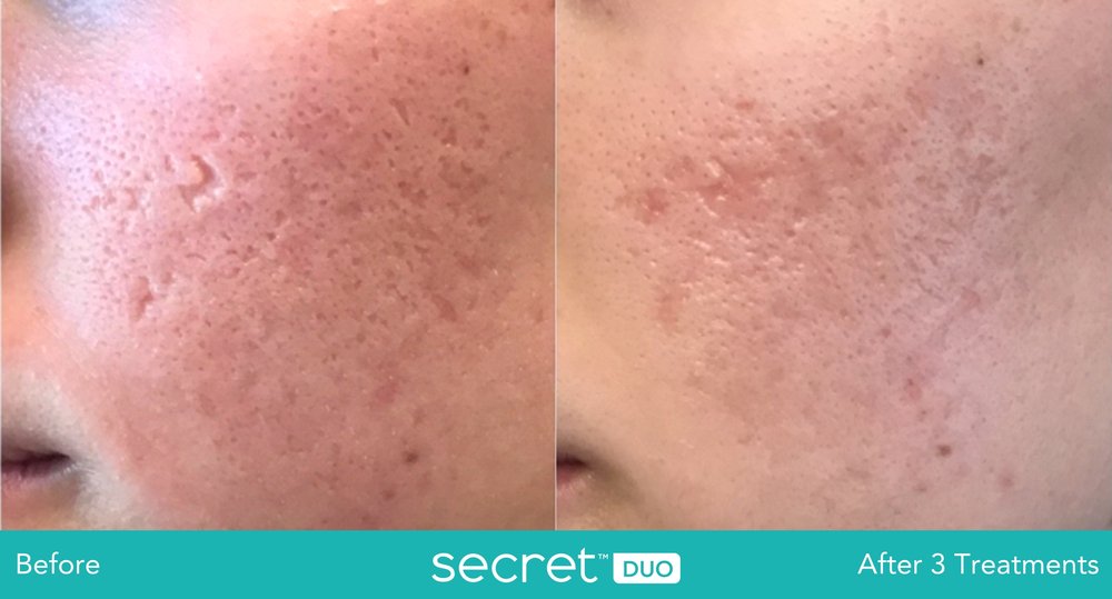 The image shows a side-by-side comparison of a person s skin before and after treatment, highlighting the results of a skincare procedure.
