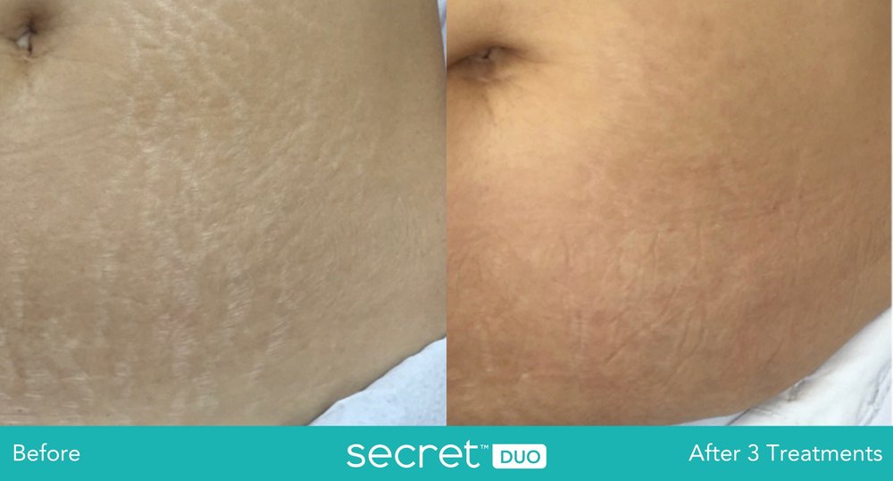 The image shows a before-and-after comparison of skin treatments, with the left side depicting a person s skin with visible imperfections and the right side showing the same area after treatment, appearing smoother and more even in tone.