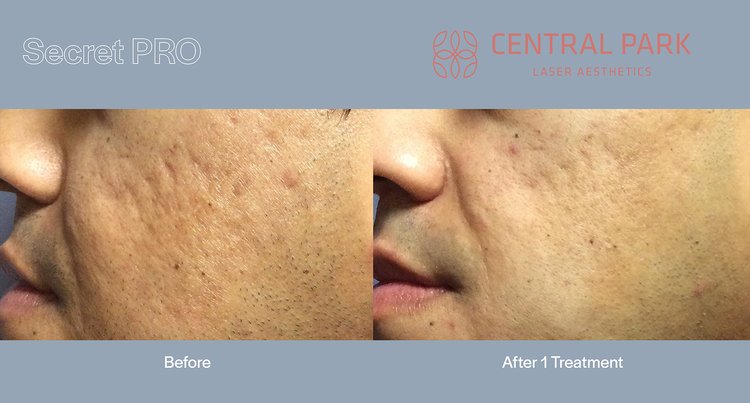 The image shows a person before and after a cosmetic treatment, likely a skin resurfacing procedure, with text indicating  Secret Pro  and  Laser Aesthetics.
