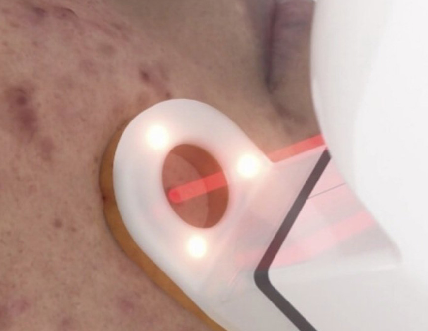 The image shows a close-up view of a person s face with acne and a lighted device attached to their skin, possibly for medical treatment or monitoring.