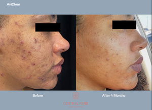 The image shows a before-and-after comparison of a person s skin condition after using a skincare product, with visible improvement in skin texture and tone.