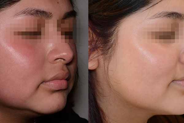 The image shows a before-and-after comparison of skin treatments, with the left side showing redness and the right side showing clearer skin.