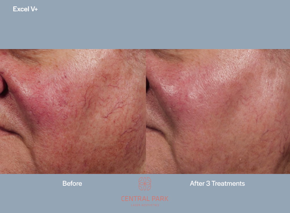 The image shows a before-and-after comparison of a person s skin, with the left side showing redness and the right side showing clearer skin after treatments.