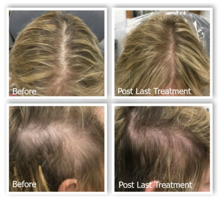 The image shows a series of four before-and-after photos of a person s hair treatment process, with text indicating the stages of  Post Last Treatment  and  Before Hair Treatment.