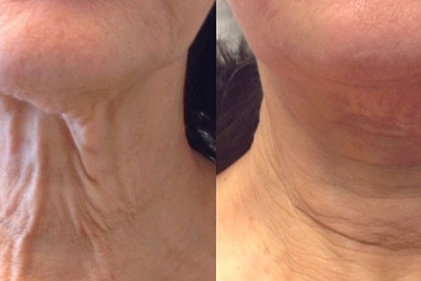 The image shows a close-up of two different areas on a person s face with visible skin texture changes, likely highlighting the effects of skincare treatments or products.