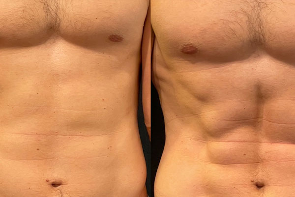 The image shows two side-by-side photographs of a person s torso, with the left side displaying a fuller appearance and the right side showing a more muscular build, both highlighting the abdominal area.