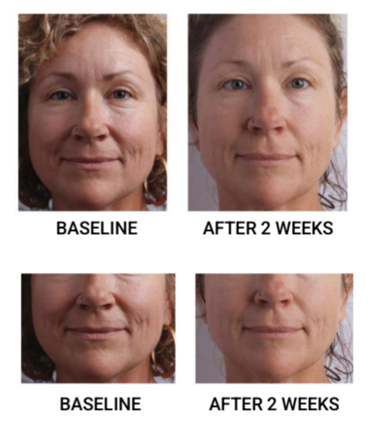 The image shows a series of four close-up photographs of a person s face at different stages of a cosmetic treatment, illustrating the results before and after two weeks, with captions indicating  baseline  and  after 2 weeks.