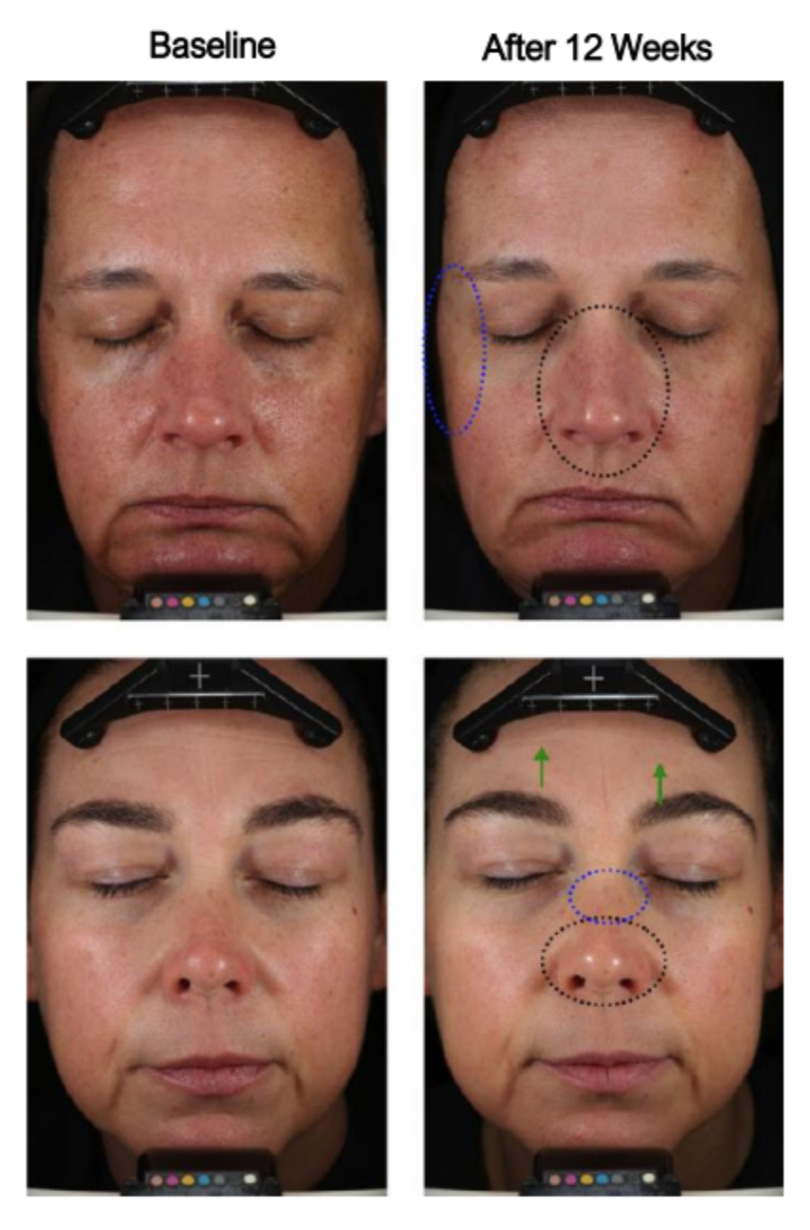 The image shows a series of four photographs displaying a person s face with different stages of a cosmetic procedure, likely involving skin treatment, with before and after comparisons highlighted by red arrows indicating the areas of change.