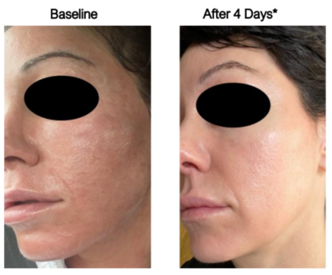The image shows a side-by-side comparison of skin before and after a cosmetic treatment, highlighting improvements such as reduced fine lines and a smoother complexion.