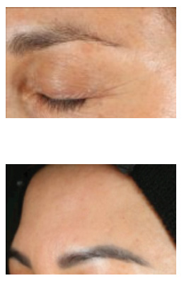 The image shows a close-up view of a person s eyelid area with cosmetic work in progress, featuring before and after images of cosmetic eyeliner application.