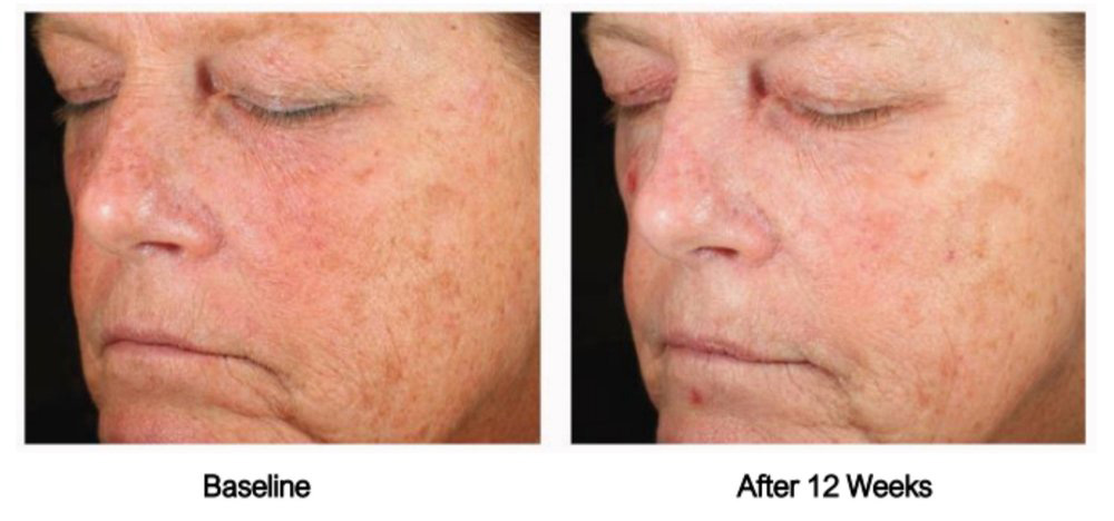The image shows a split-screen comparison of a person s face before and after a cosmetic treatment, with the  after  side displaying visible improvements such as reduced redness and smoother skin texture.