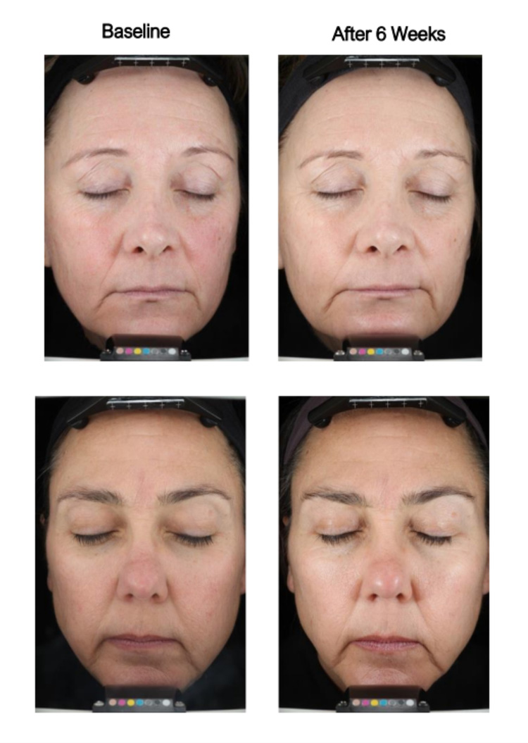 The image shows a series of before-and-after photos of a person s face after receiving cosmetic treatments, with different stages of treatment progression indicated by various time intervals such as  before 6 weeks  and  after 6 weeks.  It emphasizes the results achieved through these treatments.