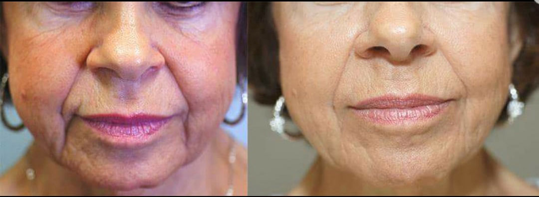 Central Park Laser Aesthetics | DiamondGlow reg  Medical Grade Facial, Rosacea Treatment and Hyperpigmentation Treatment