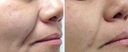 Central Park Laser Aesthetics | Skin Rejuvenation, SKINVIVE    and Botox For Sweating Treatment