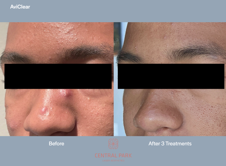 The image shows a before-and-after comparison of a person s skin, likely from a cosmetic treatment such as acne scar removal, with a blacked-out area over the treated skin to emphasize the difference.