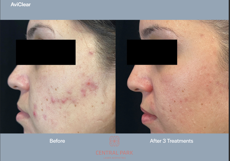 The image displays a before-and-after comparison of skin treatments, showcasing a person s face with acne lesions before treatment and the same area after treatment, highlighting improvement.