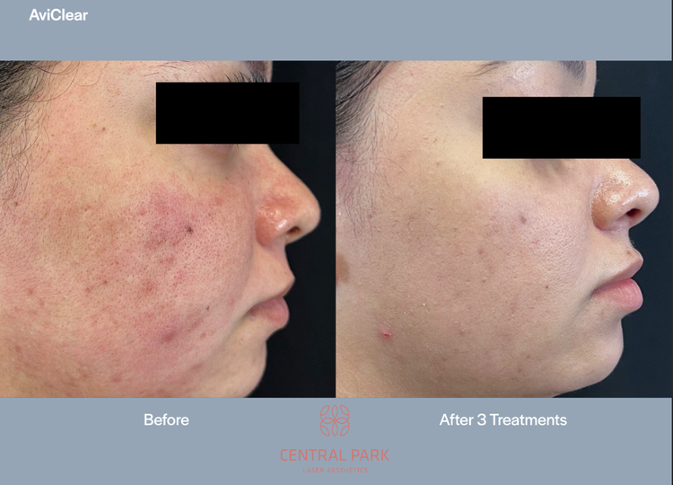 The image shows a side-by-side comparison of before and after acne treatment, with a person s face visible on both sides, highlighting the effectiveness of the treatment.