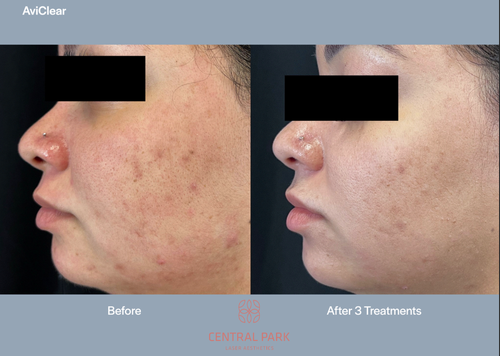 The image shows a before-and-after comparison of a person s skin condition after receiving treatments at a skincare clinic, with visible improvements in skin texture and tone.