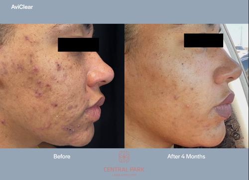 The image shows a before-and-after comparison of skin treatments, with two photographs side by side demonstrating the results of a cosmetic procedure on a person s face.