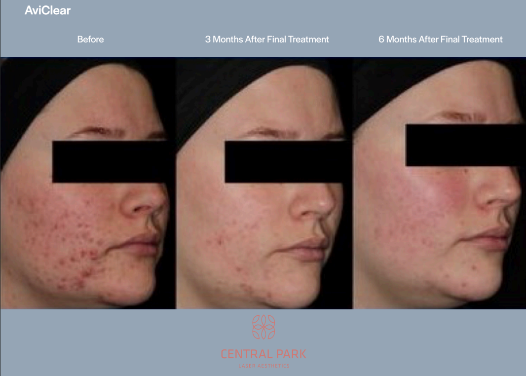 The image shows a comparison of three different stages of acne treatment on a person s face, with each stage represented by a before-and-after photo, against a white background with text labels indicating the time frames for each stage.