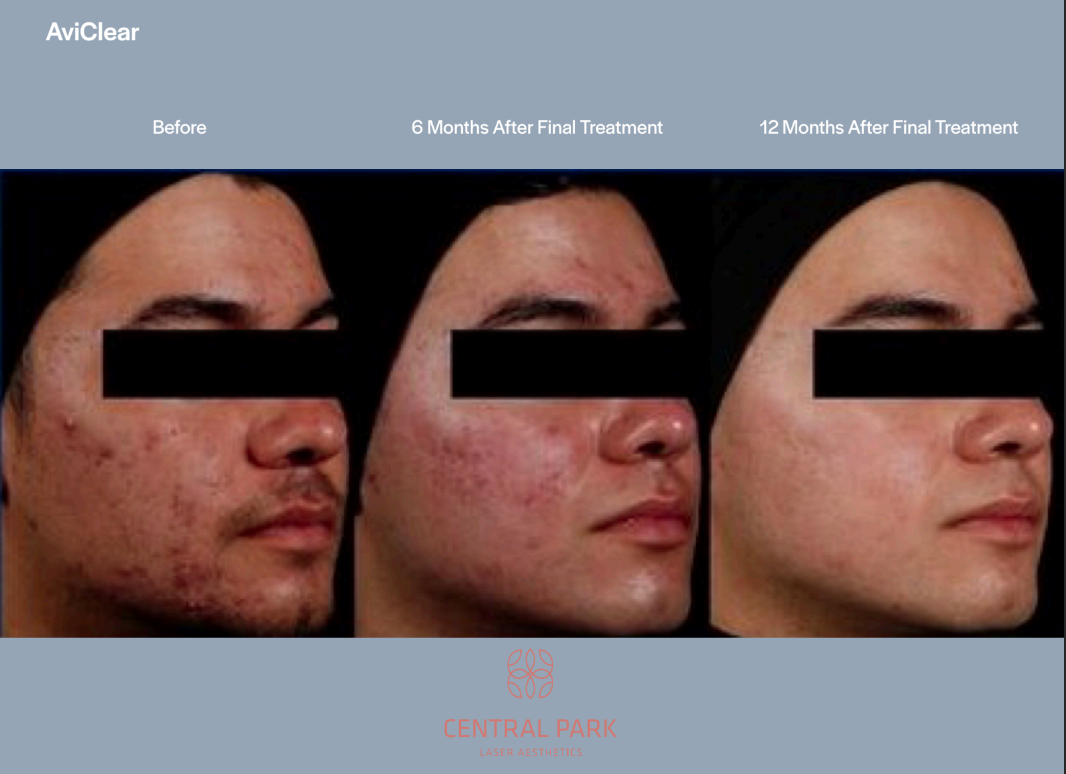 The image displays a collage of three photographs showing the same man with acne at different stages of treatment, with text indicating  before  and  after  results for a skin care product named AvivClear.