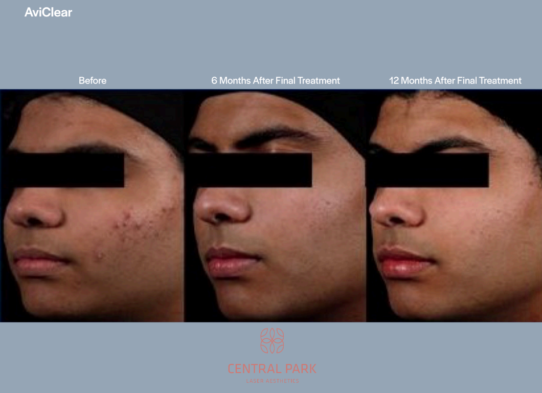 The image shows a step-by-step comparison of skin treatments with before and after images of acne treatment, presented on a website.