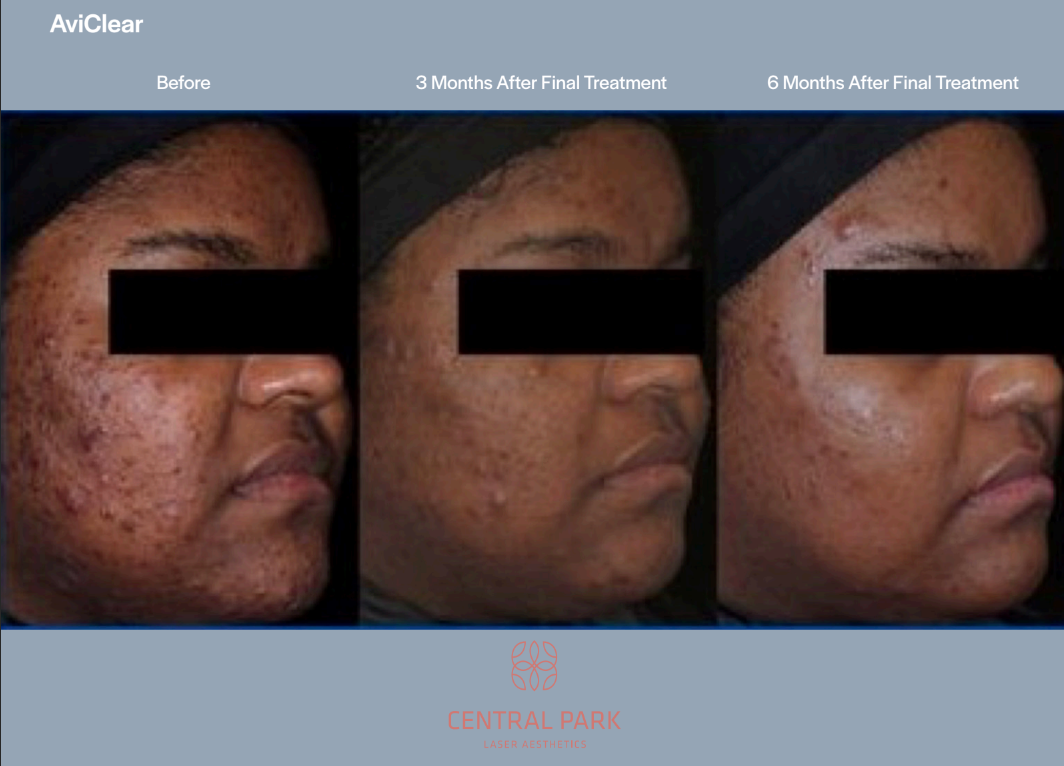 The image shows a series of before-and-after photos with text overlay indicating a transformation from acne to clear skin, highlighting a cosmetic treatment process.