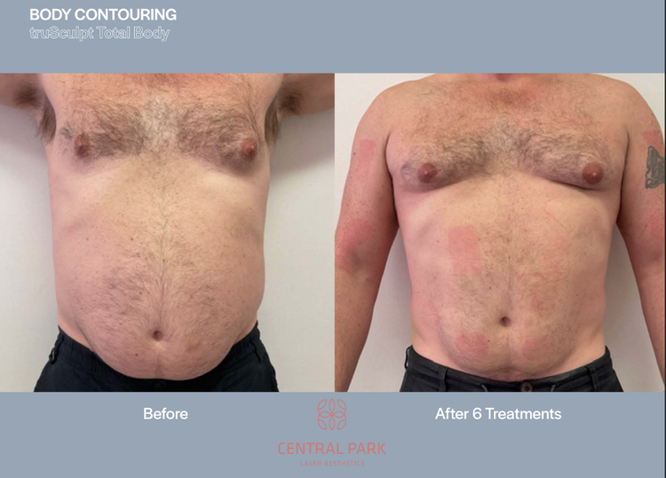 The image shows a side-by-side comparison of a person before and after a body contouring procedure, with the left side displaying the individual s pre-treatment appearance and the right showing the post-treatment result.